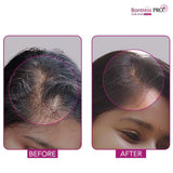 GLENMARKBONTRESSPROSCALPSERUM - Bontress PRO+ Scalp Serum Fortified with Redensyl, Anagain, Capixyl,Procapil | Hair Serum for Hair Growth & Hair Fall 30ml - Looknstyle