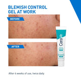 CeraVe Blemish Control Gel with 2% Salicylic Acid and Niacinamide, Treats Blemish-Prone Skin By Reducing Acne and Blackheads. Acne Spot Treatment Gel Minimises Pores & Prevents Breakouts, 40ml