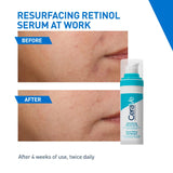 CeraVe Resurfacing Retinol Serum For Blemish-Prone Skin, Reduces Post Acne Marks & Pores, Formulated with Licorice Root Extract & Niacinamide, Non-Comedogenic, 30ml