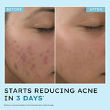 HYPENACNEDEFENICEDAILYSERUM - Hyphen Acne Defence Daily Serum For Acne Prone Skin with Salicylic acid 2%, Azelaic Acid 10%, Niacinamide 4% | Treats Active Acne, Controls Oil | AntiAcne Serum for Men & Women - 30 ml - Looknstyle