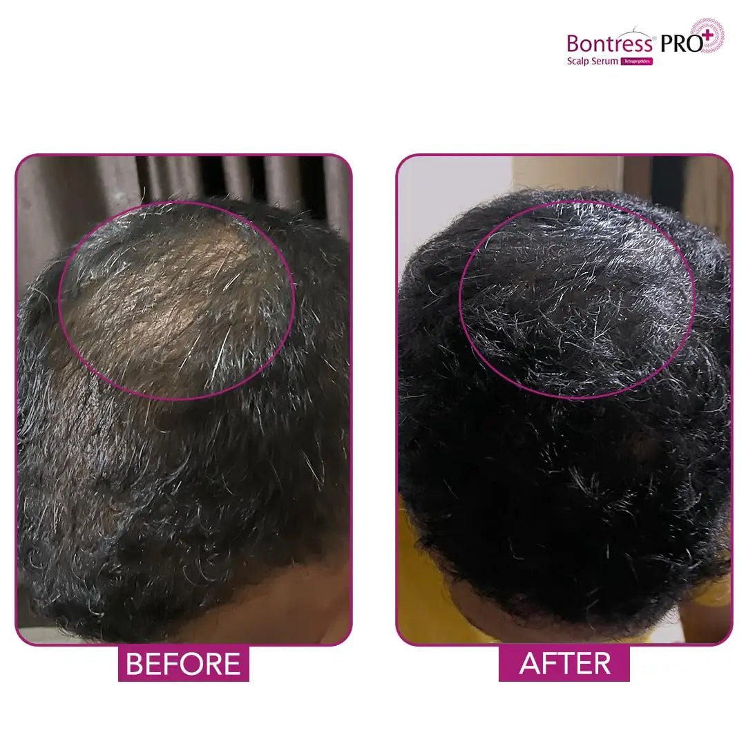GLENMARKBONTRESSPROSCALPSERUM - Bontress PRO+ Scalp Serum Fortified with Redensyl, Anagain, Capixyl,Procapil | Hair Serum for Hair Growth & Hair Fall 30ml - Looknstyle