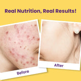 Chicnutrix Super C - Natural Vitamin C & Zinc for Clear & Acne Free Skin | 1000mg Amla Extracts (pack of 2)