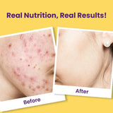 chcntxsprc - Chicnutrix Super C - Natural Vitamin C & Zinc for Clear & Acne Free Skin | 1000mg Amla Extracts - Looknstyle