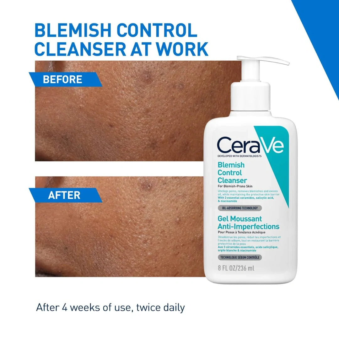 CeraVe Blemish Control Cleanser with 2% Salicylic Acid & Niacinamide for Acne Prone Skin, Controls Acne & Spots, Unclog Pores & Reduces Blemishes, 236ml