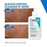 CeraVe Blemish Control Cleanser with 2% Salicylic Acid & Niacinamide for Acne Prone Skin, Controls Acne & Spots, Unclog Pores & Reduces Blemishes, 236ml
