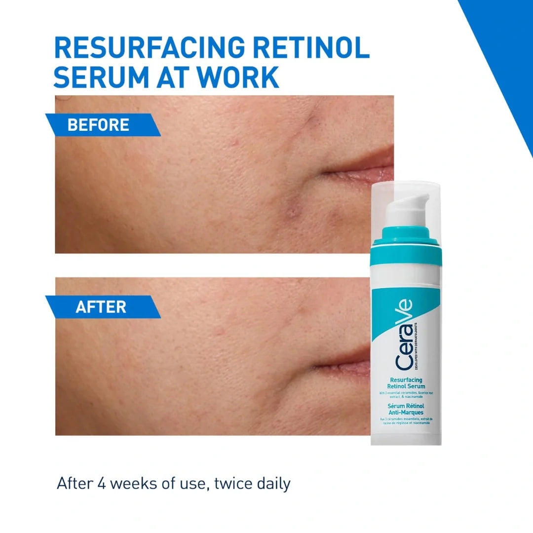 CeraVe Resurfacing Retinol Serum For Blemish-Prone Skin, Reduces Post Acne Marks & Pores, Formulated with Licorice Root Extract & Niacinamide, Non-Comedogenic, 30ml