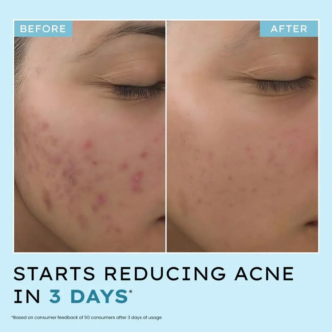 HYPENACNEDEFENICEDAILYSERUM - Hyphen Acne Defence Daily Serum For Acne Prone Skin with Salicylic acid 2%, Azelaic Acid 10%, Niacinamide 4% | Treats Active Acne, Controls Oil | AntiAcne Serum for Men & Women - 30 ml - Looknstyle