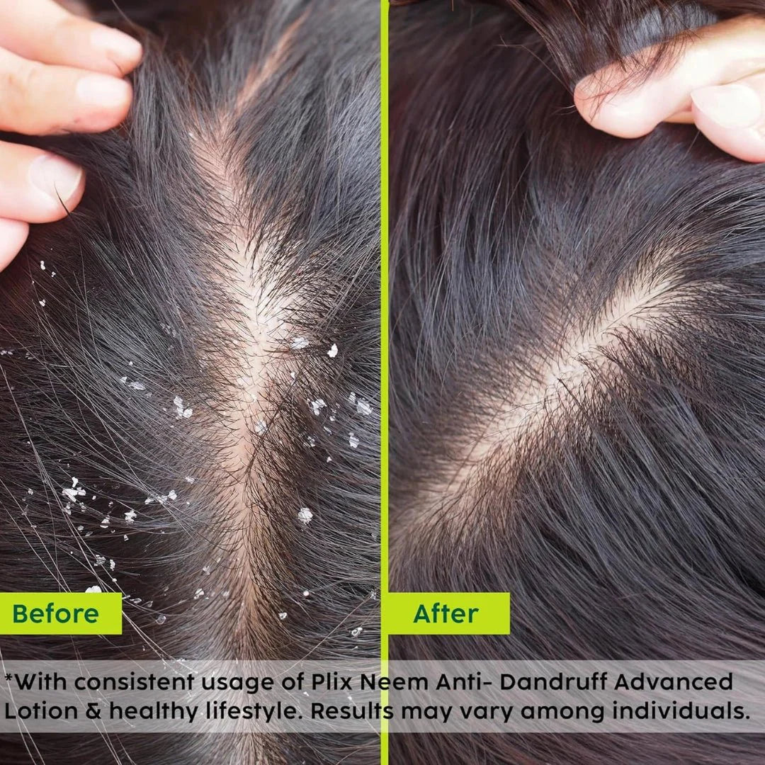 The Plant Fix Plix Neem Anti - Dandruff Advanced Lotion | Reduce Dandruff, Itching & Irritation | With Dandelix Pro & Ichthyol PALE | Paraben & Sulphate Free | Unisex (60ml) - Deals999